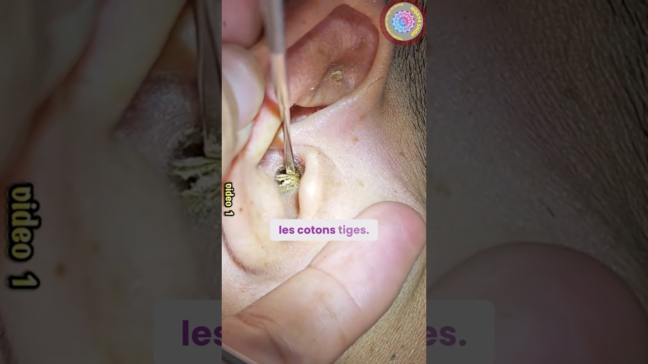 Pourquoi les O￼RL déconseille le coton-tige ?