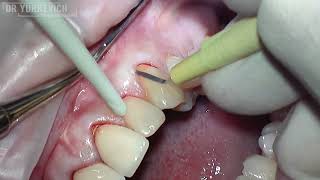 Рецессии десны, тоннельный метод без десневого трансплантата | Gum recession closure surgery w/o CTG