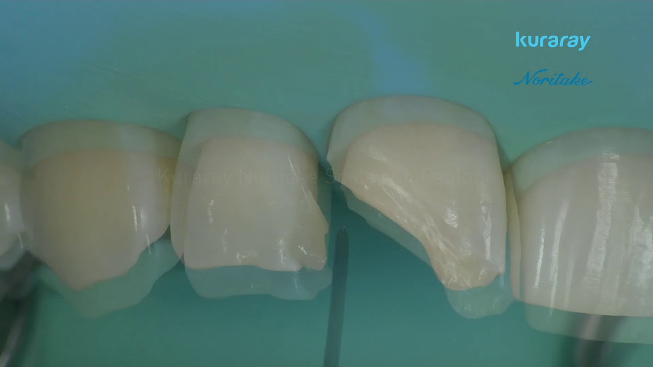 5. Restauro classe V - Restauro dei denti anteriori con CLEARFIL MAJESTY ES-2