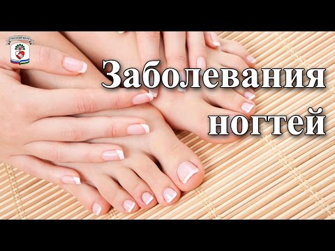 Причины и профилактика волнистых ногтей на ногах