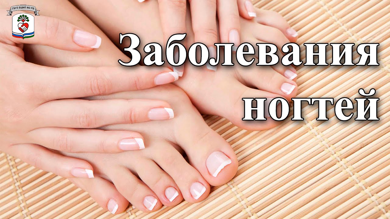 "На приеме у врача" Выпуск 13 - Заболевания ногтей