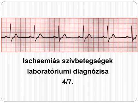 EKG: Ischaemiás szívbetegségek - Akut myocardialis infarctus laborvizsgálata_4/7