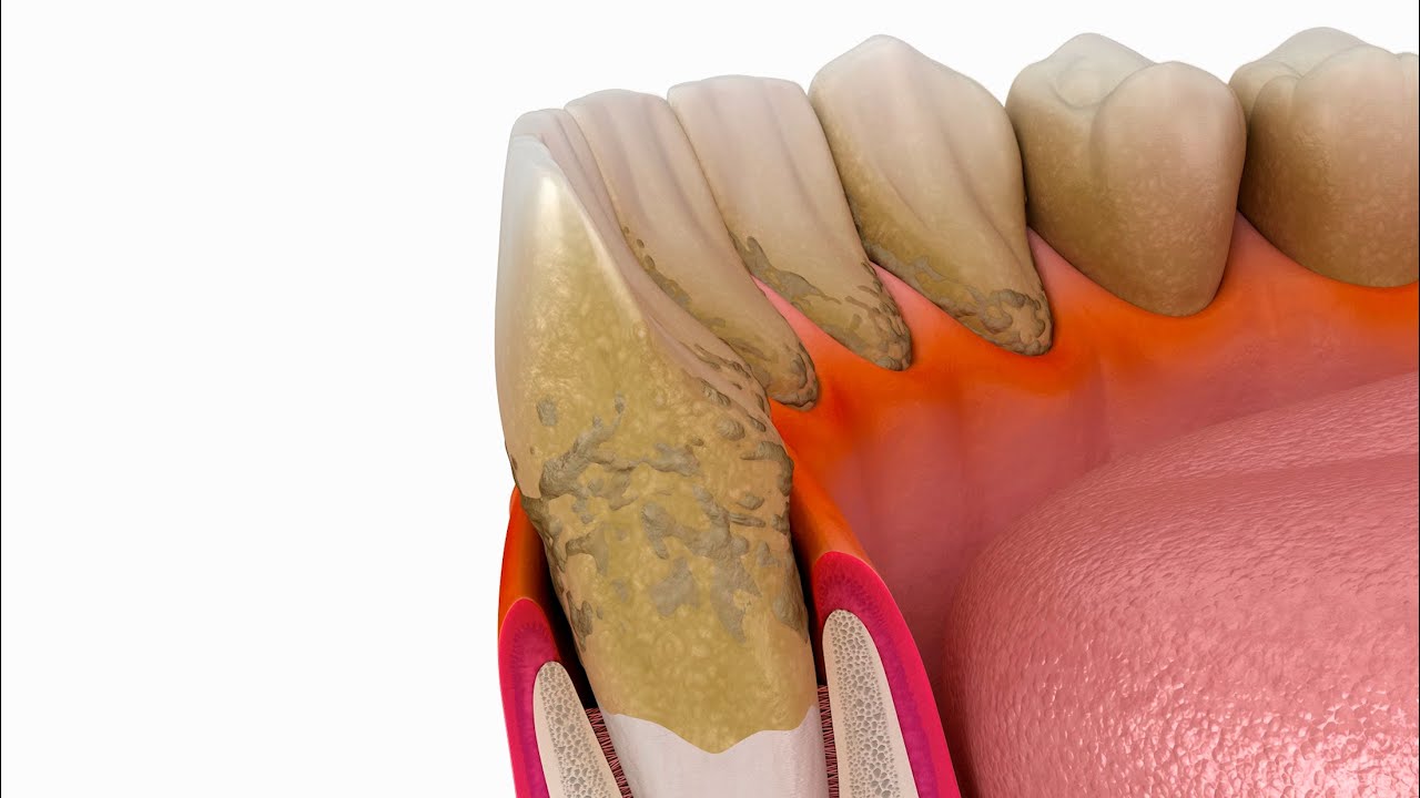Meus dentes estão ficando fracos, o que pode ser? | DenteBelo Responde ...