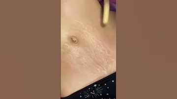 زيت الزنجبيل زيت التفاح زيت اللوزالحلو ذبدة بذور الشيا مع المساج اقوى علاج للسلوليت والتشققات 