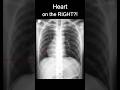 Don't Lose Marks - Circulation Assessment on a Chest X-ray (ABCDE)