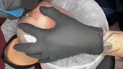 Scalp Micropigmentation Time Lapsed