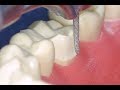 Full Gold Crown In 7 Steps Technique For Preparing The FGC On A Mandibular Molar 