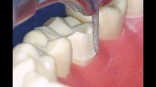 Full Gold Crown in 7 Steps | Technique for Preparing the FGC on A Mandibular Molar