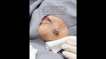 The Cute Mandibular Cyst