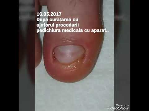 Pedichiura medicala ploiesti