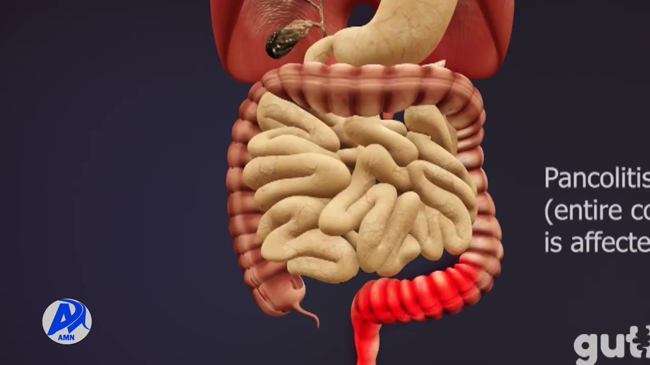 የአንጀት ቁስለት    አዲስ ሚዲያ ኔትወርክ መጋቢት 12/2014 ዓ.ም