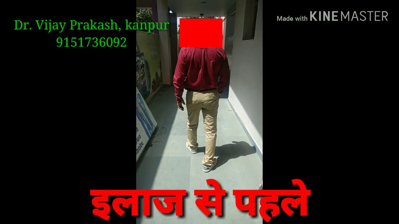 thigh pain when walking AVN | THR option | coredecompression | stem cell | Ayurvedic TreatmentDr. Vijay Prakash 9151736092