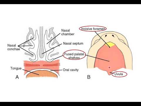 Video: Cleft Palate Rau Hauv Cov Dev Thiab Menyuam Dev