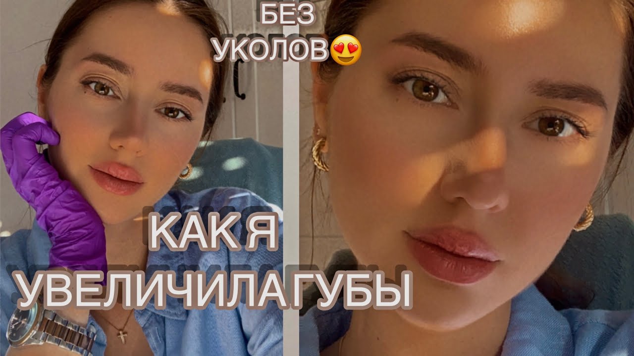 Увеличиваю губы гиалурон пен | Коррекция спустя 5 месяцев + СЕКРЕТ КАК СДЕЛАТЬ ГУБЫ БОЛЕЕ ПУХЛЫМИ