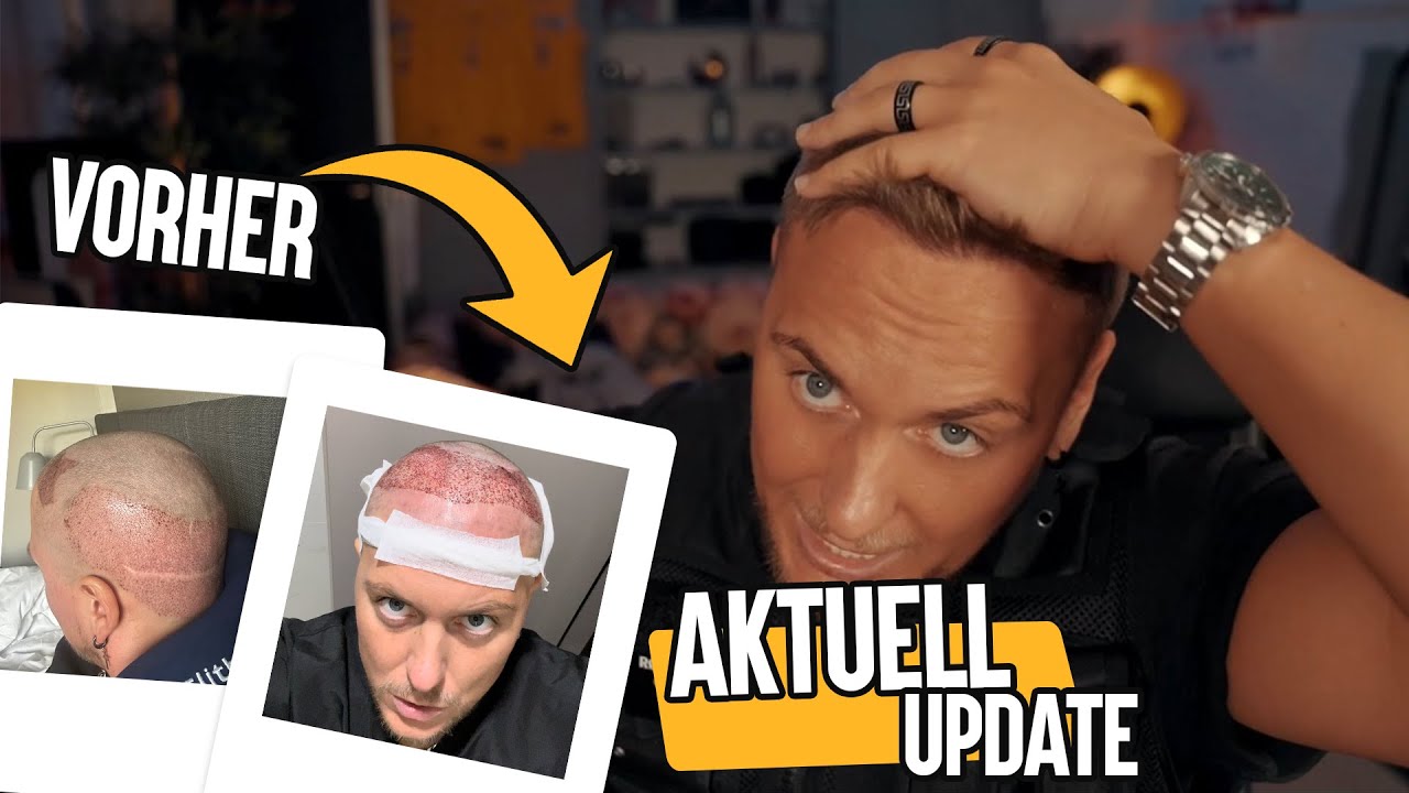 Meine fünfte Haartransplantation - 6 Monate nach der OP in der Türkei bei Elithair.
