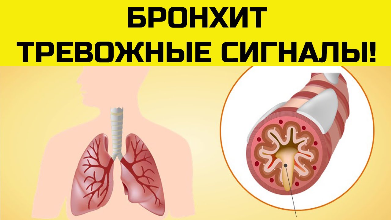 Б бронхит. Острый бронхообструктивный бронхит. Острый бронхит с синдромом бронхиальной обструкции. Обструктивный бронхиолит. Бронхит острый хронический обструктивный.