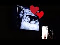 My First Time Hearing The Baby’s Heart ! 🥹