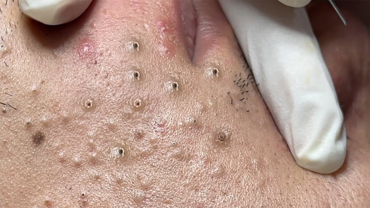 Remove Blackheads and Hidden Acne At Loan Nguyen Spa 81 YouTube
