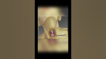 Total thyroidectomy: how thyroidectomy is performed (3d animation) #thyroidproblems #thyroidsurgery