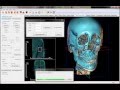 4D Superimposition with Pre and Post Orthognathic Surgery CBCT Scans
