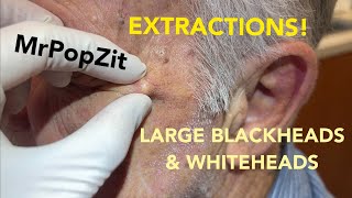 Awesome acne extractions! Some solar comedones (Favre), some regular blackheads and whiteheads