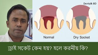 Why Does Dry Socket Occur In Teeth What To Do If It Occurs Causes Of Dry Socket And How To Ma