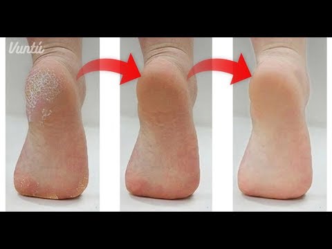 remedios naturales para la artritis 5 trucos caseros para tener pies perfectos Tu novio no dejará de besarlos