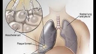 Mesothelioma Low Firm, Mesothelioma Attorneys, Asbestos Lawyers in San Diego