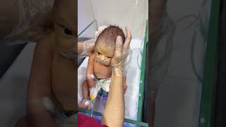 Hypatoma of newborn baby #neonatologist #neonatalcare #baby #newborn #cute #infant