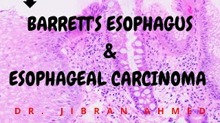 BARRETTS ESOPHAGUS AND ESOPHAGEAL CANCER II GIT II ROBBINS 10TH E II PATHOLOGY LECTURES II