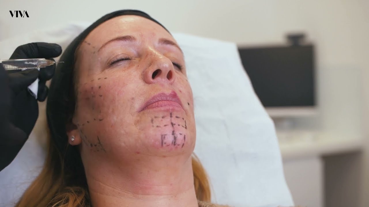 Dermal Filler VS Anti-Wrinkle