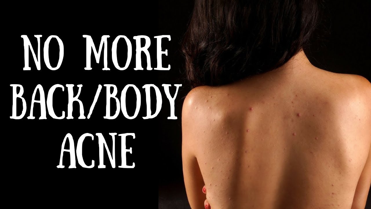 How to get rid of body acne in just 7 Days DIY Back & Body acne
