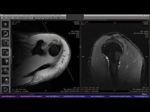 Video: Elasticitatea Aortică După Relieful De Coarctare Aortică: Compararea Terapiei Chirurgicale și Intervenționale Prin Imagistica Prin Rezonanță Magnetică Cardiovasculară