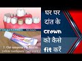 How to fix tooth crown at home in case of emergency-Dr.Praveen Bhatia