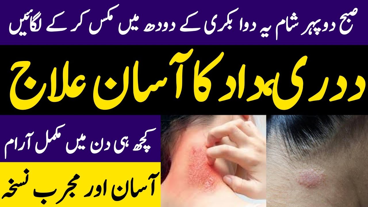 How To Remove Fungal Infection Dadri , Dad Ka ilaj Hakeem Zia