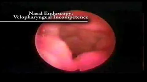 Endoscopy- Velopharyngeal Incompetence