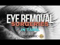 Types of EYE REMOVAL SURGERIES explained in tamil #eyecare #optometry #eyesafety Eye Removal sx