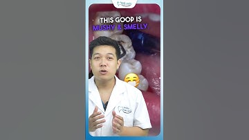 Lỗ Sâu Trên Răng To Nguy Hiểm Như Thế Nào | Nha Khoa Minh Châu