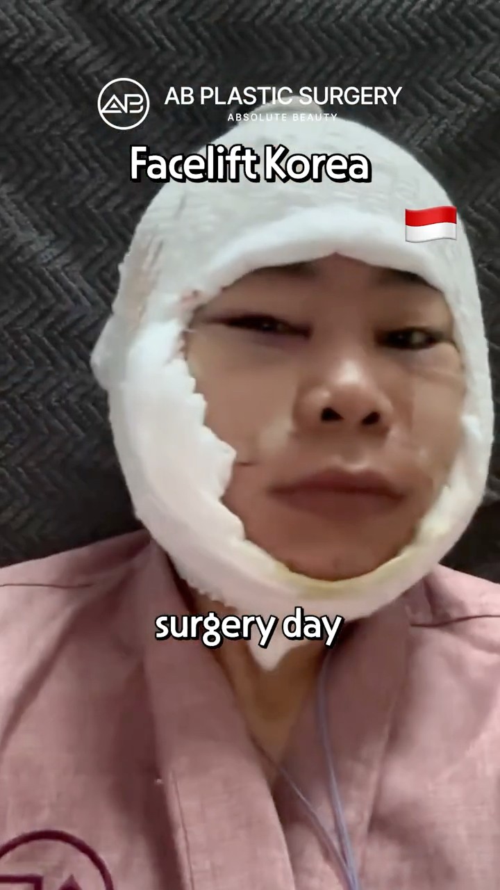 I Got a Facelift in Korea… Here’s My 2 Month Change #shorts