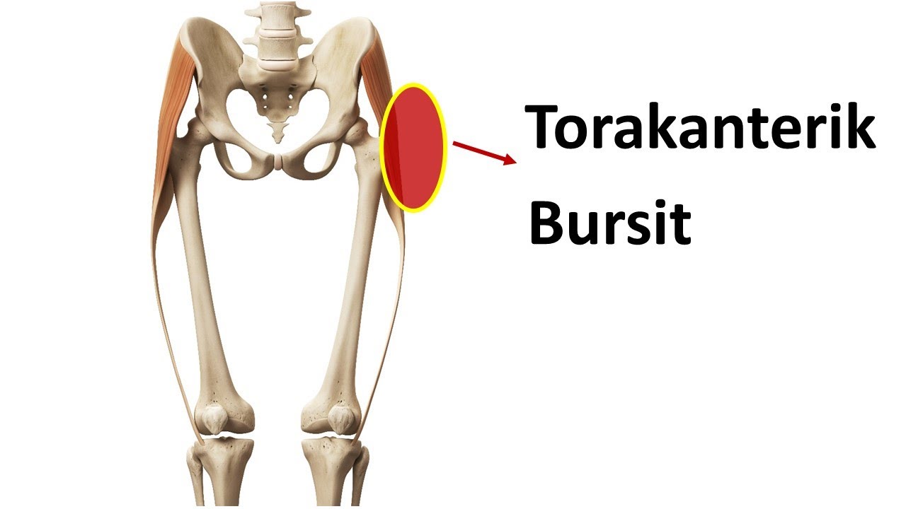 Torakanterik Bursit