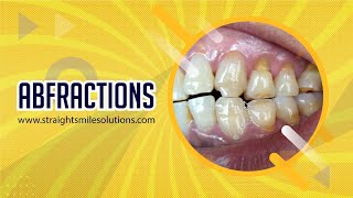 Abfractions https://www.straightsmilesolutions.com/