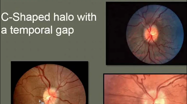 Courtney Francis, M.D. - Idiopathic Intracranial Hypertension