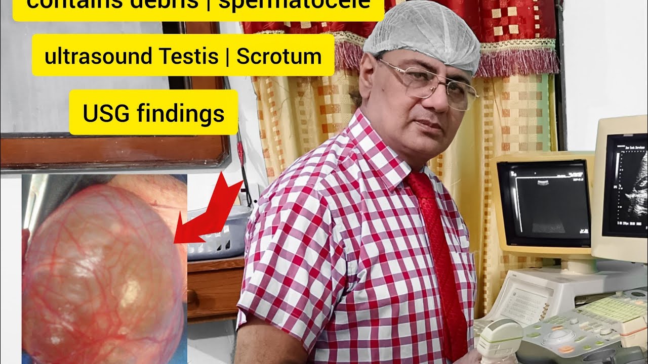 Яички | Киста придатка яичка | Дебри | Сперматоцеле Местоположение 