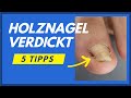 Holznagel verdickt? 3 Tipps Nagel schmerzfrei bearbeiten