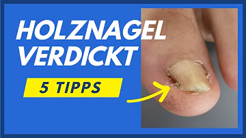 Was tun bei Nagelverdickung?