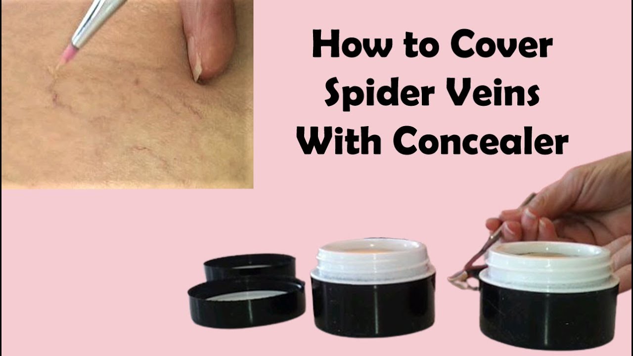 How To Er Spider Veins You