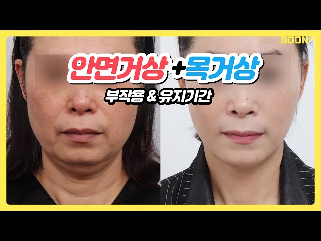 [CN] 안면거상술과 목거상술 어떤 사람이 할까?ㅣ부작용부터 유지기간까지ㅣ순플러스성형외과