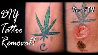 DIY Tattoo Removal! - Steve-O