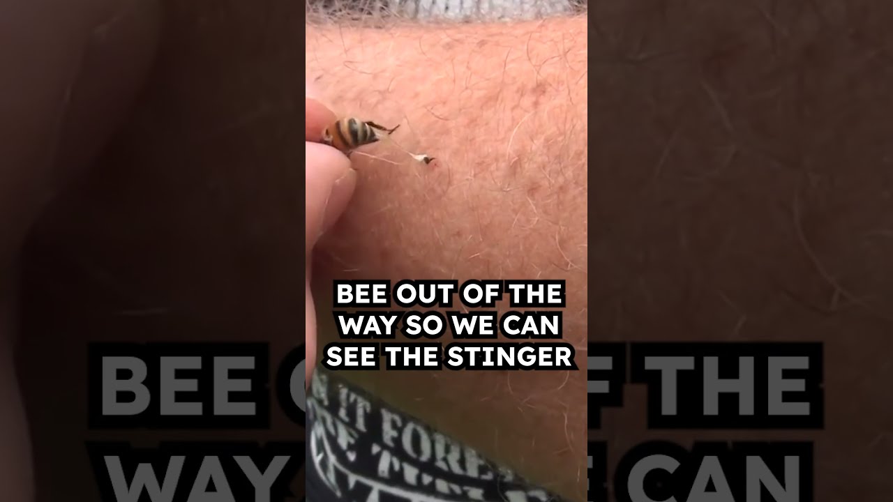 How To Remove Bee Sting
