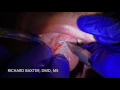 CO2 Laser Frenectomy of Adult with Anterior Tongue Tie